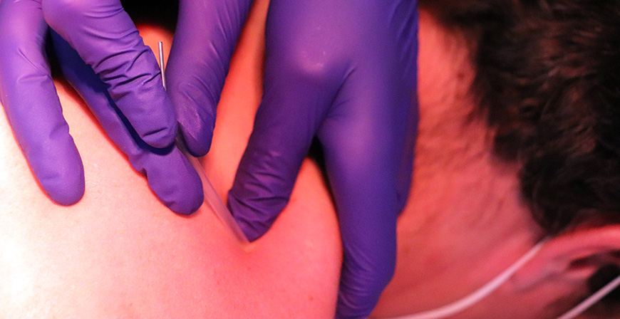 Experimenta los beneficios de la terapia Indiba Activ y la puncin seca en Centro Mdico Ro Ebro