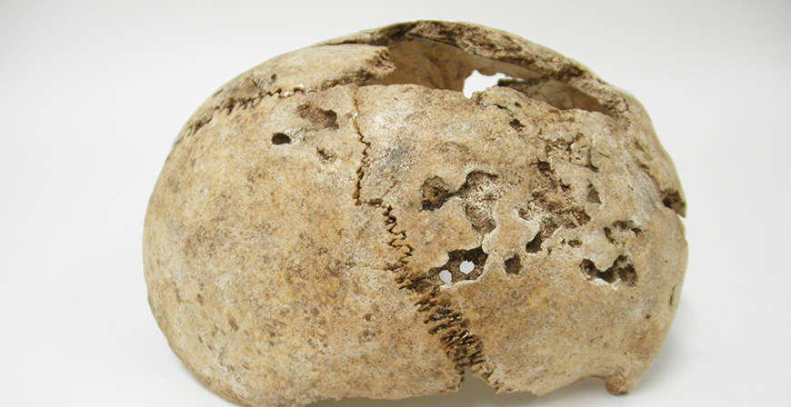El primer y más antiguo vestigio de sífilis hallado en el norte de España procede de Fresno del Río