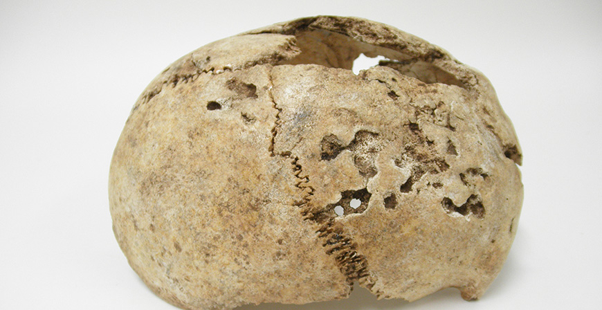 El primer y ms antiguo vestigio de sfilis hallado en el norte de Espaa procede de Fresno del Ro