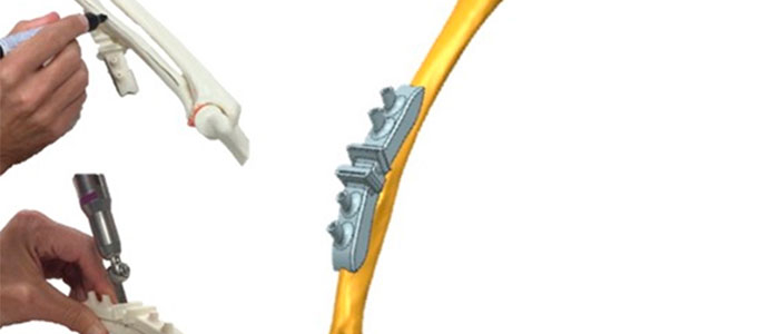 Valdecilla y el Hospital Virtual integran la tecnologa de impresin 3D en tratamientos quirrgicos