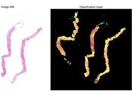El Servicio de Anatom�a Patol�gica de Valdecilla avanza en el primer algoritmo de IA desarrollado para el cribado del c�ncer de pr�stata